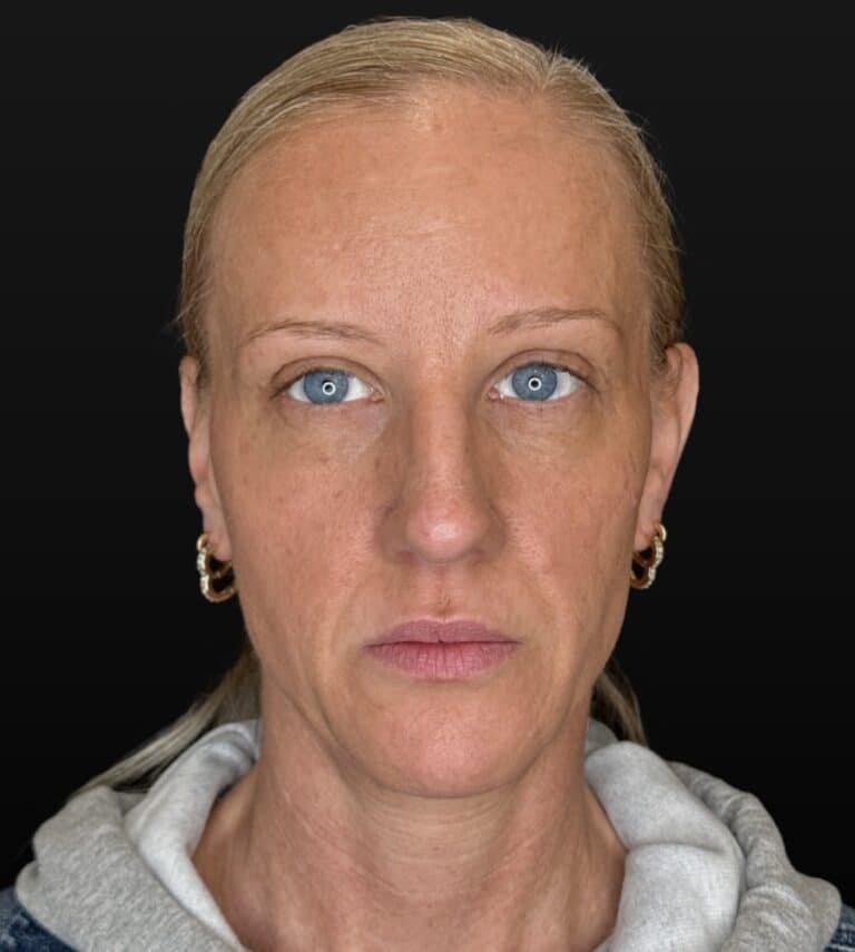 After Image: Case #10523 – Mid and Lower face filler, Lip filler - front