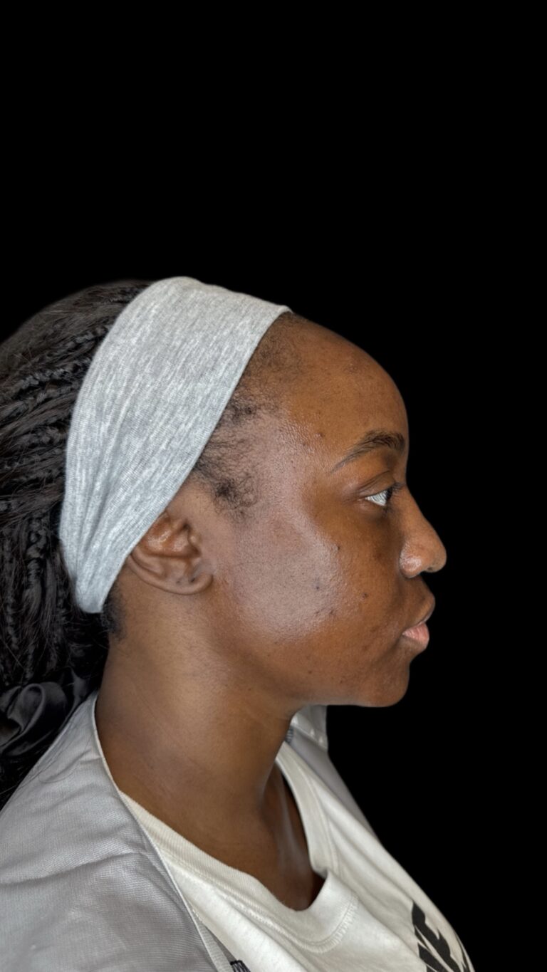 After Image: Case #10624 – Chin filler for facial balancing - front