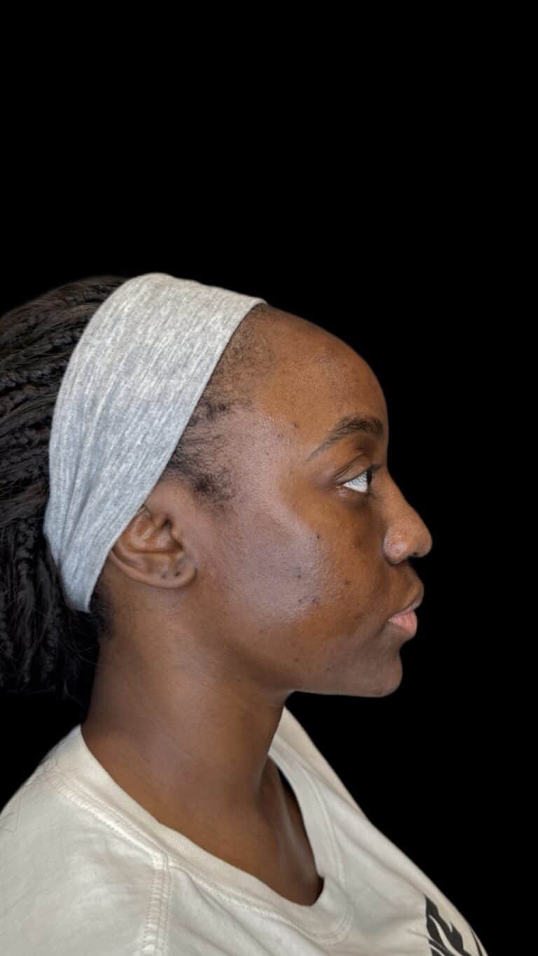 Before Image: Case #10624 – Chin filler for facial balancing - front