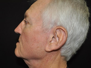 Case #4024 – Facelift