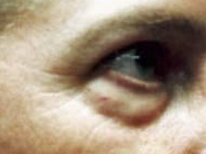 Case #2146 – Eyelid Surgery