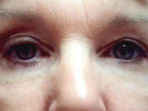 Case #2140 – Eyelid Surgery