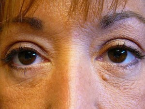 After Image: Case #2130 – Eyelid Surgery - other