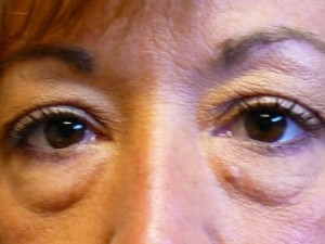 Before Image: Case #2130 – Eyelid Surgery - other