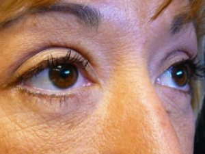 After Image: Case #2130 – Eyelid Surgery - right-front-oblique