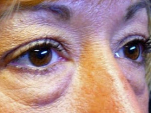 Before Image: Case #2130 – Eyelid Surgery - right-front-oblique