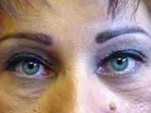 After Image: Case #2120 – Eyelid Surgery - other