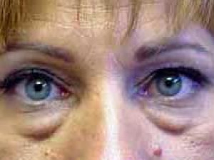 Before Image: Case #2120 – Eyelid Surgery - other