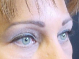 After Image: Case #2120 – Eyelid Surgery - right-front-oblique