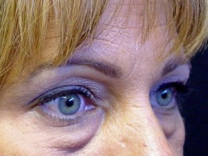 Before Image: Case #2120 – Eyelid Surgery - right-front-oblique