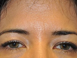 Case #5048 – Eyelid Surgery