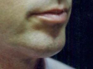 After Image: Case #2162 – Chin Enhancement - right-front-oblique