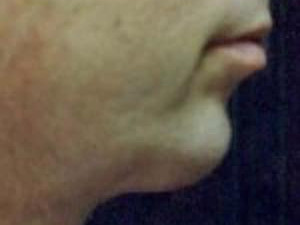 After Image: Case #2162 – Chin Enhancement - other