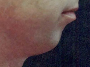 Before Image: Case #2162 – Chin Enhancement - other