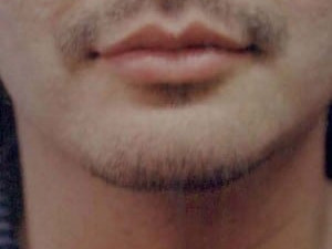 After Image: Case #2157 – Chin Enhancement - front