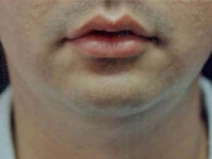Before Image: Case #2157 – Chin Enhancement - front