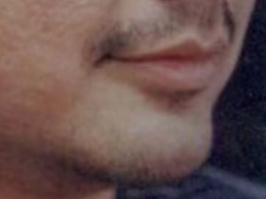 After Image: Case #2157 – Chin Enhancement - right-front-oblique