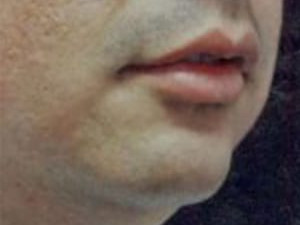 Before Image: Case #2157 – Chin Enhancement - right-front-oblique