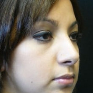 Case #2228 – Rhinoplasty