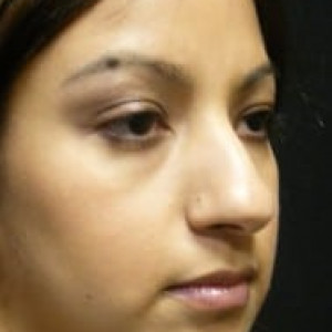 Case #2228 – Rhinoplasty