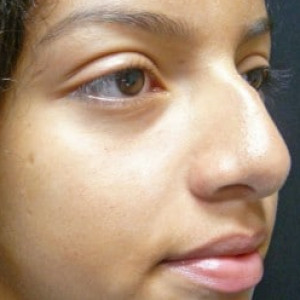 Case #2233 – Rhinoplasty