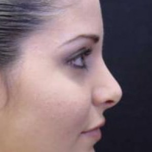 Case #2207 – Rhinoplasty