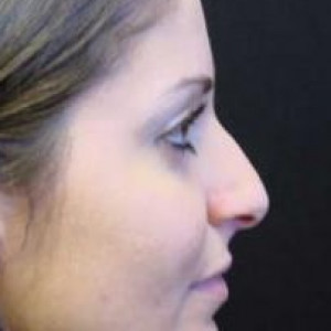 Case #2207 – Rhinoplasty
