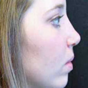 Case #2202 – Rhinoplasty