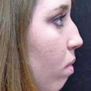 Case #2202 – Rhinoplasty