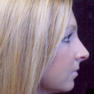 Case #2197 – Rhinoplasty
