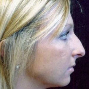 Case #2197 – Rhinoplasty