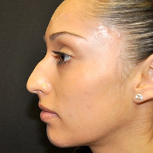Case #3624 – Rhinoplasty