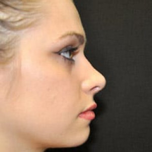Case #3653 – Rhinoplasty