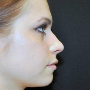 Case #3653 – Rhinoplasty