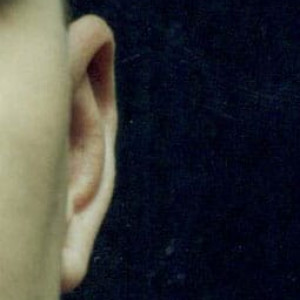 After Image: Case #2247 – Ear Reshaping - front