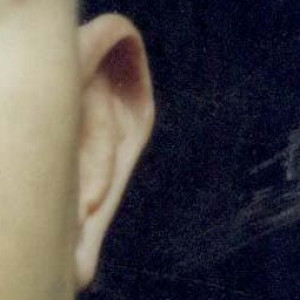 Before Image: Case #2247 – Ear Reshaping - front