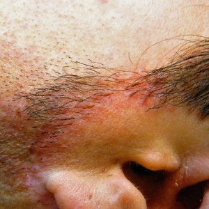 Case #2648 – Acne Scar Treatment