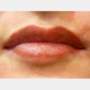 After Image: Case #0138 – Acne Scar Treatment - other