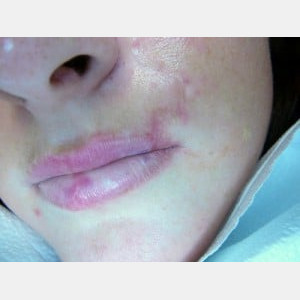 Case #0138 – Acne Scar Treatment
