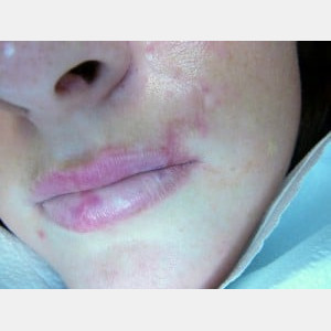Before Image: Case #0138 – Acne Scar Treatment - other