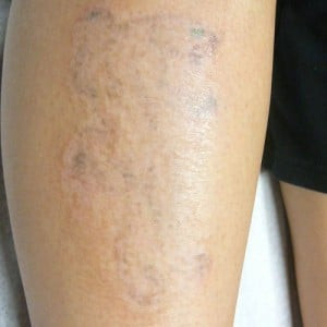 Case #2676 – Laser Tattoo Removal