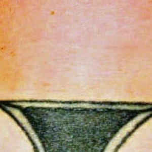 After Image: Case #2670 – Laser Tattoo Removal - other