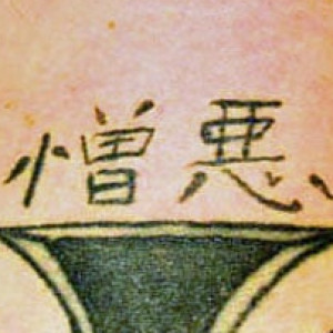 Before Image: Case #2670 – Laser Tattoo Removal - other