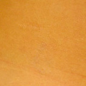 Case #2667 – Laser Tattoo Removal