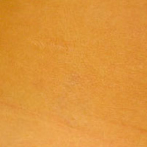 After Image: Case #2667 – Laser Tattoo Removal - other