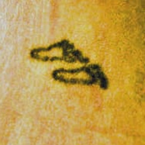 Before Image: Case #2667 – Laser Tattoo Removal - other