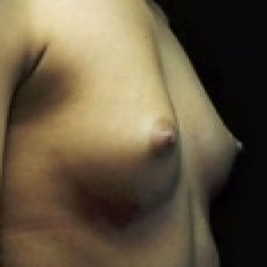 Case #2285 – Breast Augmentation