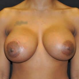 Case #5059 – Breast Augmentation