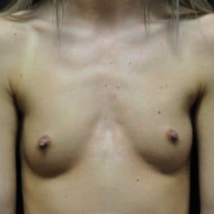 Case #5057 – Breast Augmentation