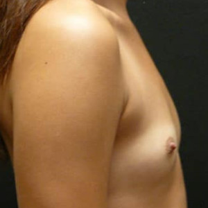 Case #5189 – Breast Augmentation